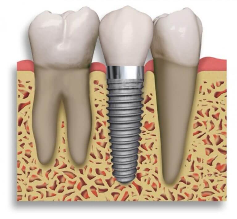 Implant Dentaire Terrebonne