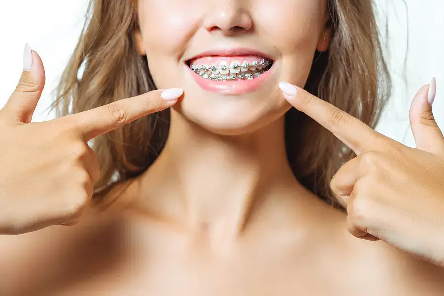 Broches métalliques pour traitement orthodontique à Terrebonne