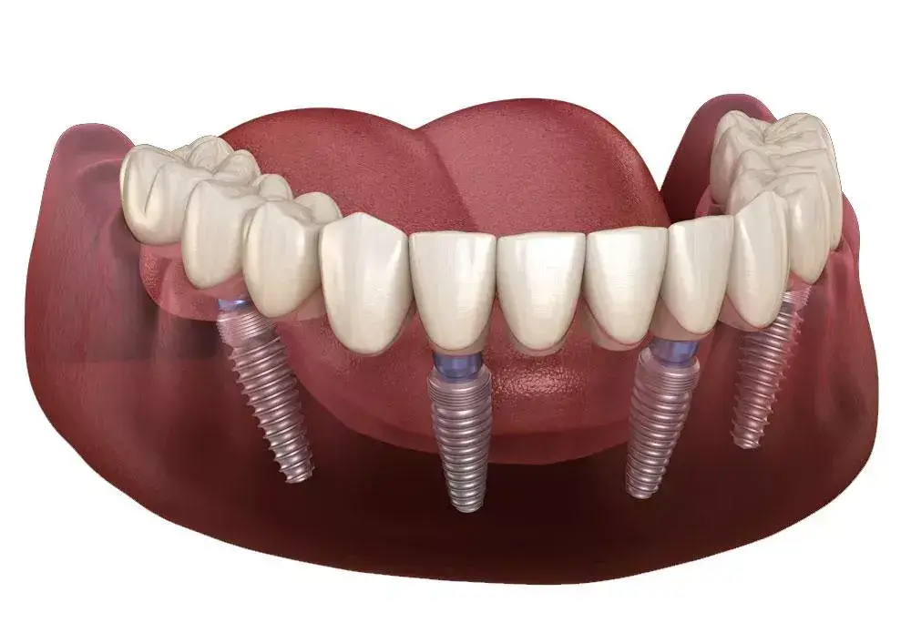 Prothèse complète All-on-4 sur implants dentaires Terrebonne